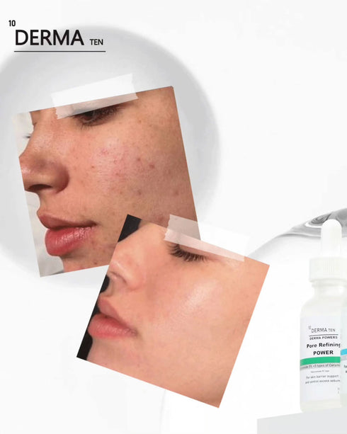 ديرما تن سيروم نياسيناميد لتصغير المسام و تنظيم افرازات الدهون 30 مل - derma 10